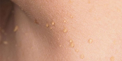 Picture of skin tags